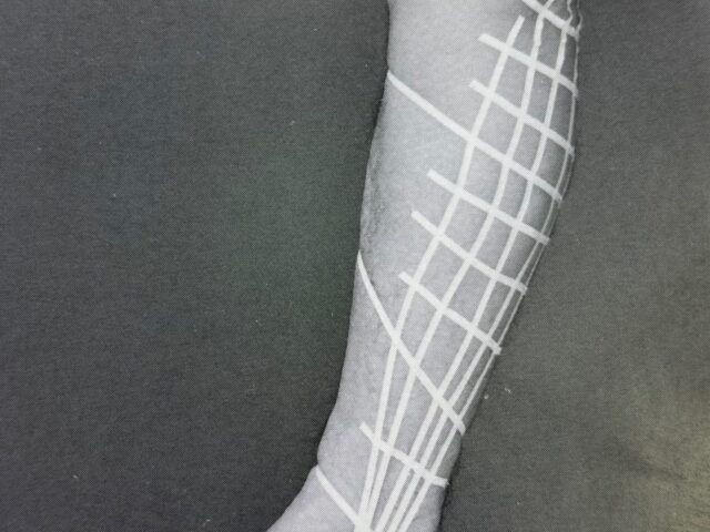 肉離れについて